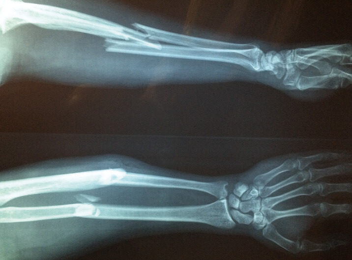 Röntgenbild eines gebrochenen Armes