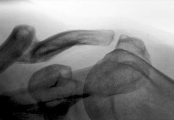 Acht Monate nach dem Unfall, schräg von oben/hinten gesehen. Die Bruchstücke sind durch Callus verbunden (links oben; steife Pseudoarthrose). Das Schlüsselbeingelenk, das dem Schulterblatt oberen Halt gibt, ist auseinandergezogen (der Spalt rechts oben), da das Schlüsselbein um ca. anderthalb Zentimeter verkürzt ist, und muss eine neue Bewegungsabfolge finden.